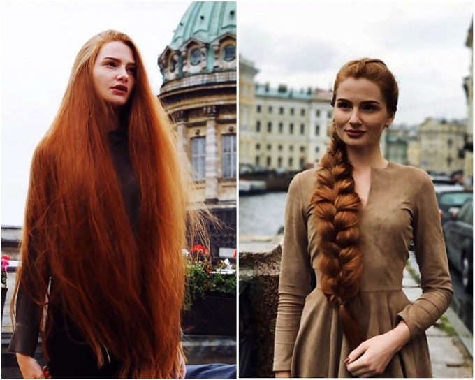 俄羅斯23歲的西多羅夫曾患雄性激素脫髮，現時為洗頭水廣告模特兒。網圖
