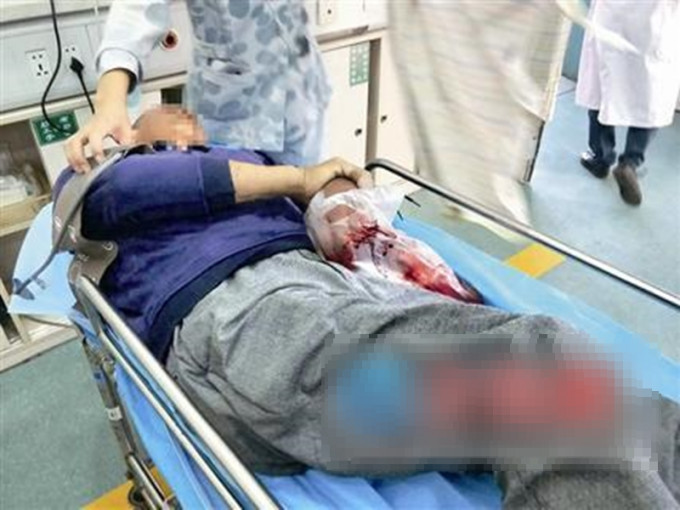 福建漳州一位老翁遭毒蛇咬傷手指，即場自斷手指「保命」。  網上圖片