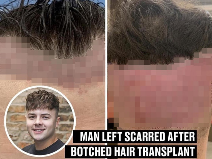 26歲英國男花逾萬植髮，頭皮傷痕像被「蟲卵」覆蓋。(網圖)