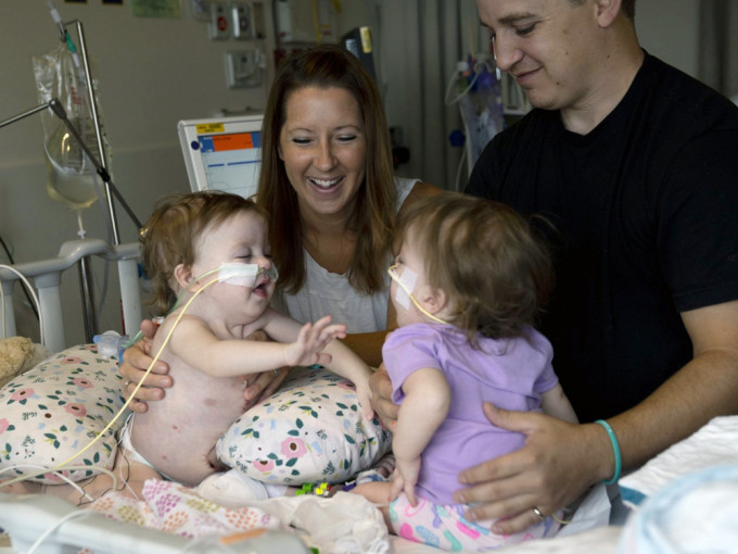 一歲連體雙胞胎女嬰歷11小時手術成功分離。AP圖片