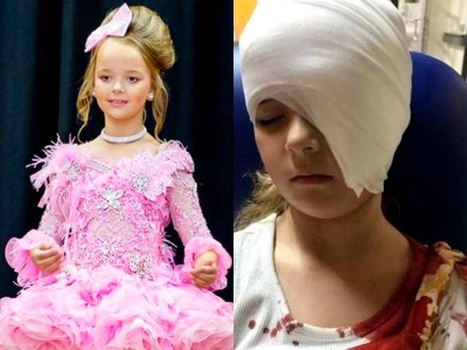 6歲女童遭吊扇割臉縫100針留疤痕，重拾自信再踏選美舞台。網圖