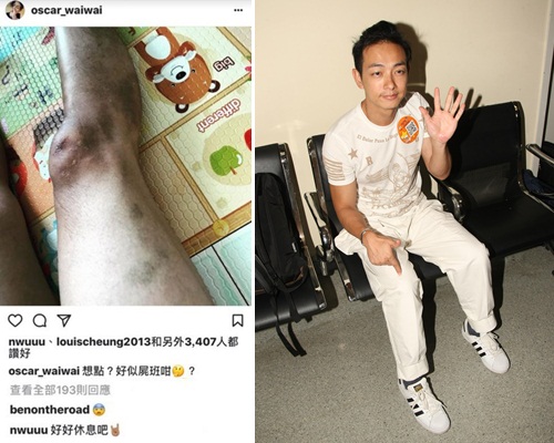 唯唯晒的傷腳頗嚇人，網民跟同事都祝他早日康復。