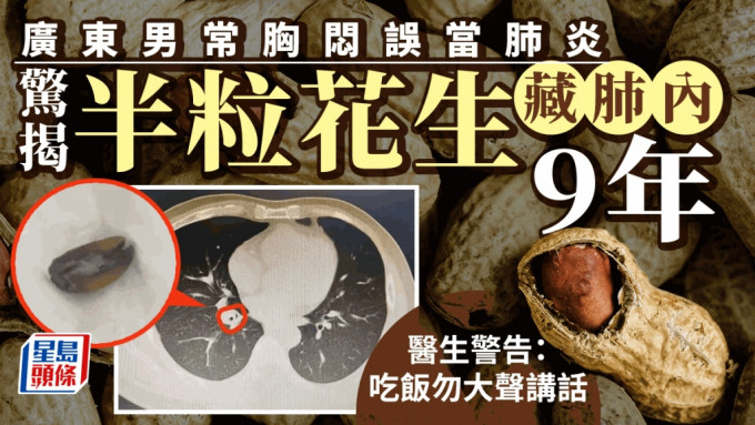 半粒花生藏肺裏｜廣東男常胸悶被誤診 竟因8-9年前食花生出事