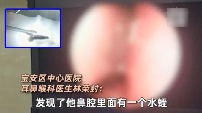 深圳市民陈先生行山时用山澜水洗面，被水蛭爬入鼻。