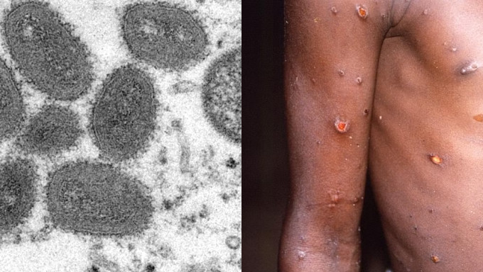 中疾控：10月新增127宗猴痘確診病例。 路透社
