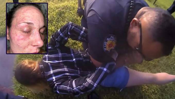被警察按压草地，美国女子脸部被红火蚁严重咬伤。