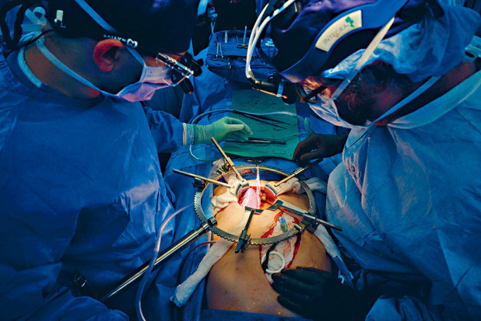 外科醫生團隊7月中動手術，將豬腎植入腦死男子體內。
