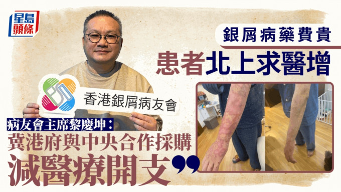 銀屑病藥費貴  患者北上求醫增  病友會 : 冀港府與中央合作採購減醫療開支