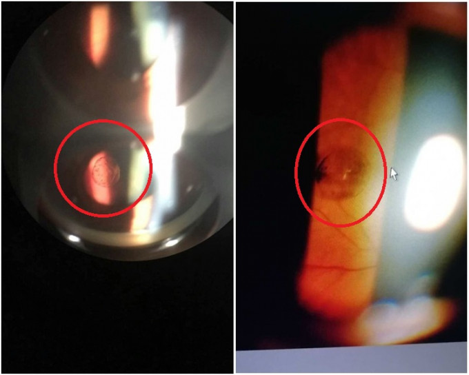 浙江宁波60岁老翁因长期养狗，狗身上的寄生虫传染到其身上，在其眼内形成像「珍珠」的幼虫体卵泡。网图