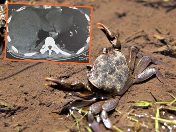 貴州男子誤信傳聞生食蟹，致全身感染寄生蟲多器官衰竭。網圖