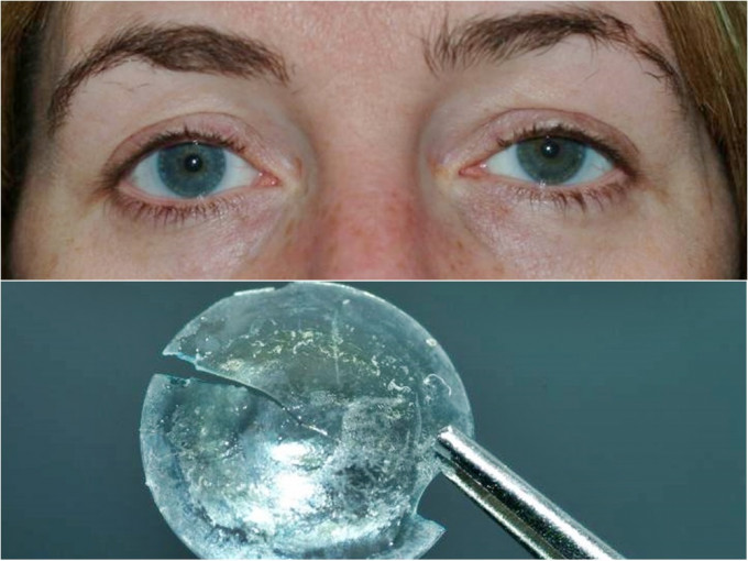 英國一名婦女因左眼腫痛求醫，發現左眼藏有一片隱形眼鏡28年。網圖