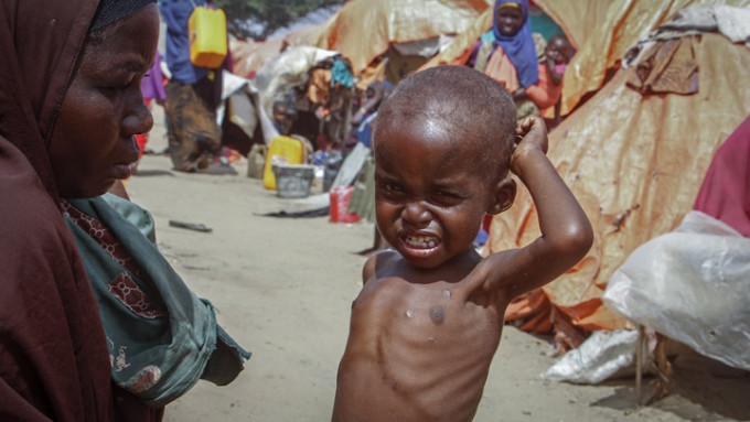 联合国儿童基金会指逾700童在索马里营养中心死亡。AP资料图片