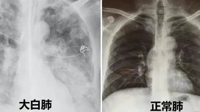 白色肺X光片引起變異致命病毒恐慌。