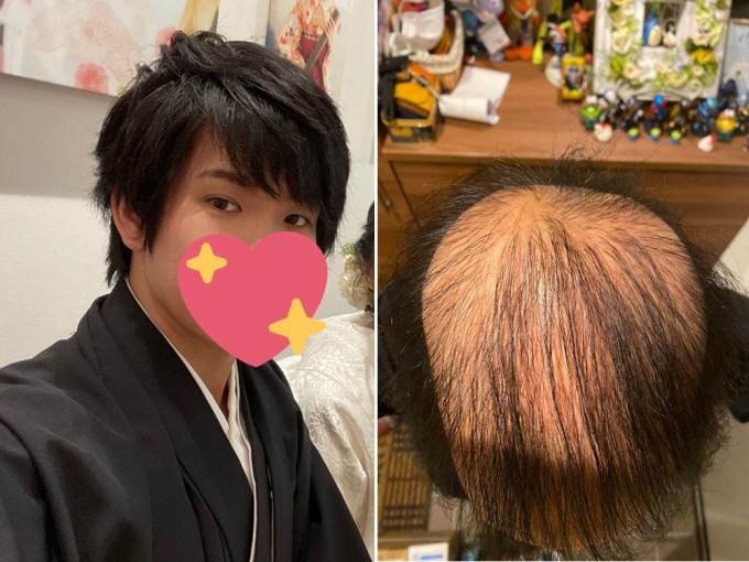 日本一名男子打完莫德納疫苗後在網上紀錄狂掉髮的情況。網圖