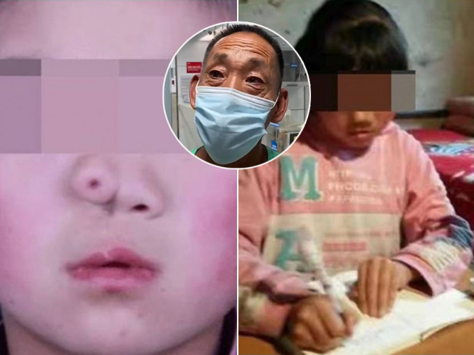 女嬰因鼻子缺陷被拋棄，窮養父艱辛養大今考上醫學院。