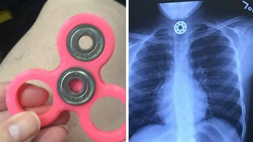 美国一名10岁女童玩指尖陀螺误食零件险窒息。网上图片