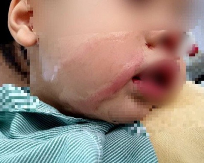 男嬰右臉還有大片面積灼傷。網圖