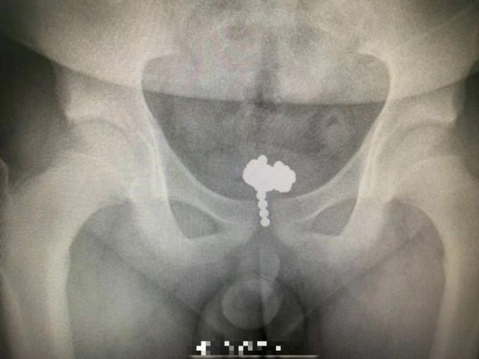 從X光片，可見其體內的磁珠。　微博圖片