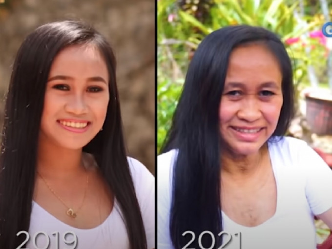 菲律賓少女患早衰症，兩年來樣貌急速老化。 （網上圖片）