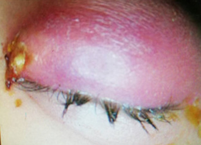 4隻活汗蜂撞入眼，引致化膿，引發蜂窩性組織炎。(網圖)