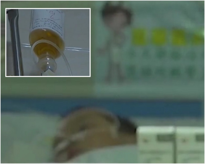 安徽阜阳一名8岁女童因贪玩，将洗衣液注入4岁弟弟的治病输液瓶中令其中毒。网图