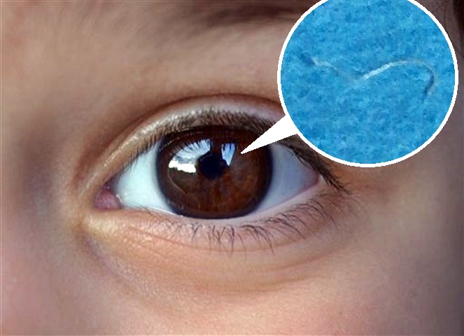 医生在小童眼球取出1.5厘米寄生虫(小图)。示意图片