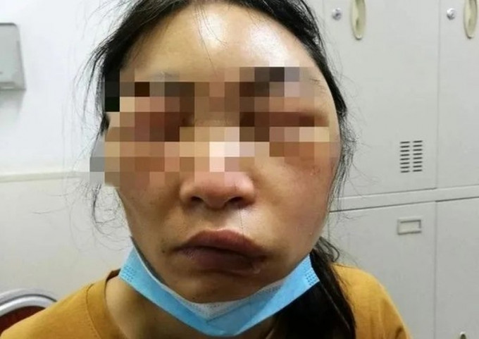 女子睡醒臉部暴腫差點窒息，以為被蚊叮，醫生估計是蜘蛛所咬。（網圖）