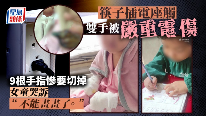 四川女童将筷子插入电座，9根手指须被切。网上图片