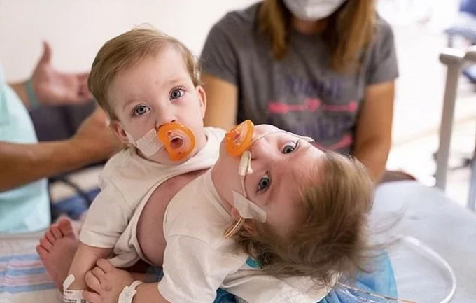 連體雙胞胎女嬰出生時由胸部至肚臍已經是相連的。AP圖片