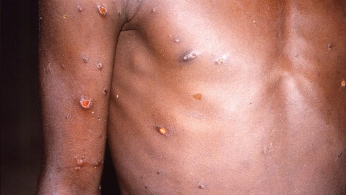 ​政府呼吁市民继续提高警觉预防感染猴痘。路透社图片