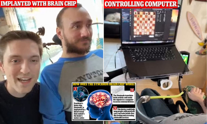 首名植入Neuralink晶片的患者阿博用意念玩电脑游戏及下棋。网上图片