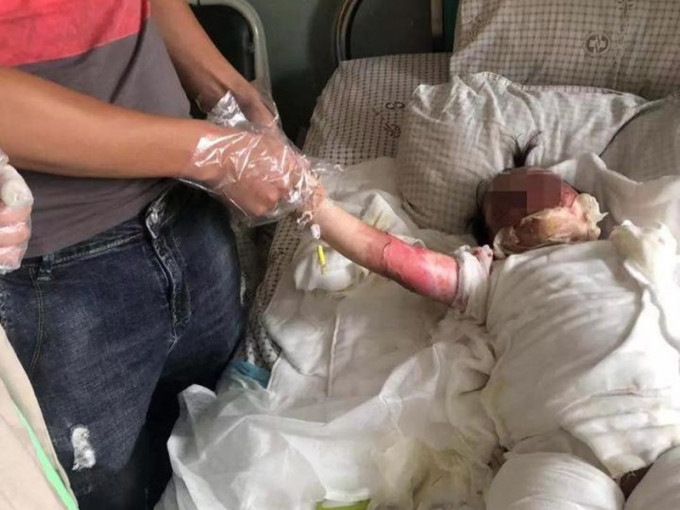 浙江一名两岁女童不慎摔进油锅里，造成全身60%被烧伤。 网图