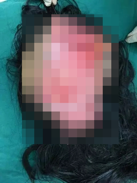 浙江塑胶厂女工头皮遭扯开。网上图片
