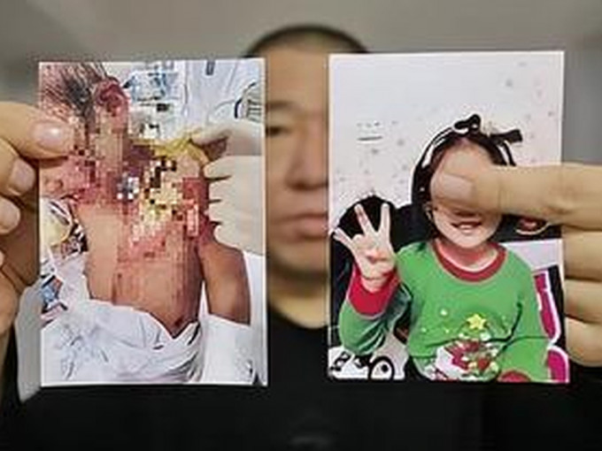 辽宁6岁女童被虐至生命垂危，父亲望严惩前妻，并且会争回抚养权。