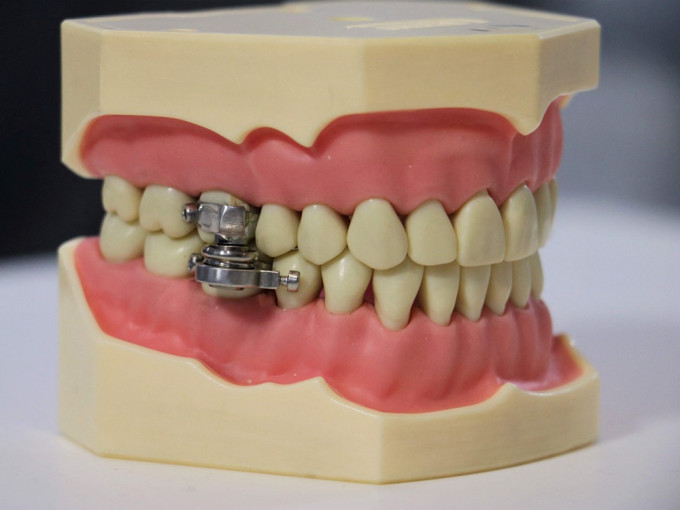 紐西蘭研究人員研發出1種新的減肥裝置，將磁鐵安裝在人的牙齒上，使人們不能容易張口。紐西蘭奧塔哥大學圖片