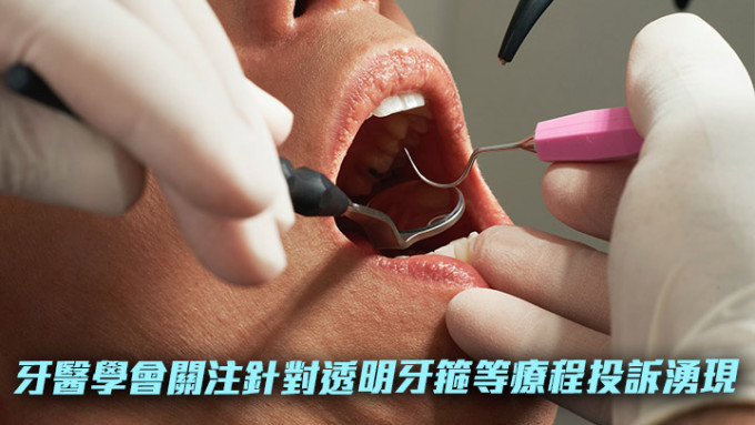 牙醫學會關注透明牙箍療程等投訴湧現。Unsplash示意圖，非涉事人