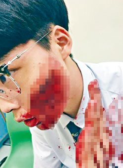 ■遭原子筆割傷面部的男生，其恐怖傷口照片曝光。