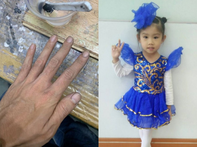 油漆工暖爸为不让女儿难堪，强忍痛楚用强溶剂洗手，到学校观看女儿表演。(网图)