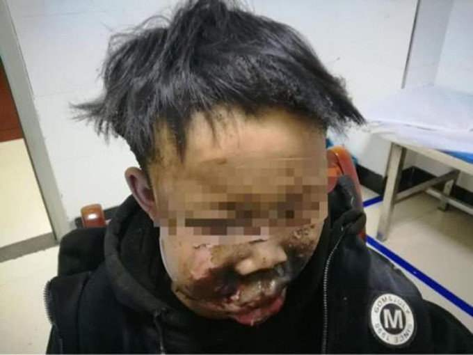 湖南郴州一位被炮仗炸伤的13岁少年，被炮仗炸得面目全非，成为今年寒假第一名被炮仗炸伤的孩子。（网图）