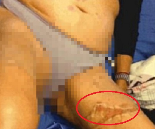 薩拉斯索拉諾的雙腿嚴重燙傷，需要進行植皮手術。 網上圖片