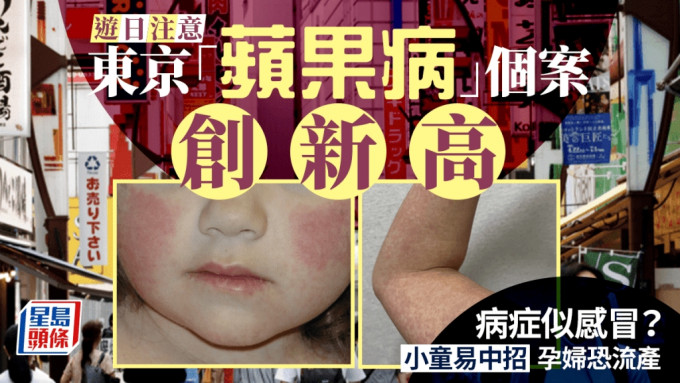 游日注意｜东京等地「苹果病」个案创新高 小童易中招 孕妇恐流产