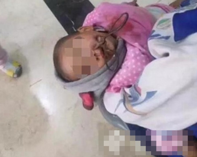 雲南一名兩歲男童不慎跌倒把剪刀直插臉部。網上圖片