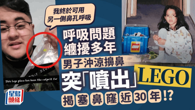 美國一名男子近日將卡在鼻裏近30年的細小樂高積膠噴出，頓時感到豁然開朗。