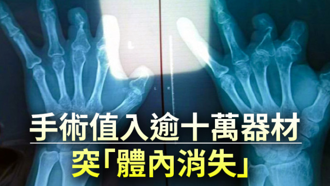 鄭州男子5年前接受手部手術，但X光片發現應當使用的貴價手術器材都「消失不見」。