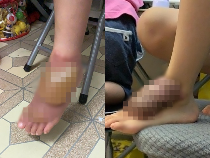 网民帖出家姐的儿子脚部渌伤的两张相片。「公务员secrets」Facebook专页相片