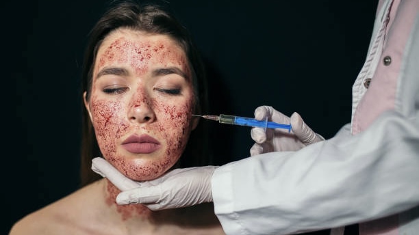 美国3名女子证实透过一间美容院的「吸血鬼美容」疗程感染爱滋。 iStock配图