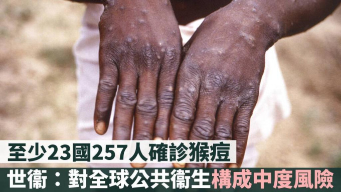 至少23個國家出現猴痘缺陣者。AP資料圖片