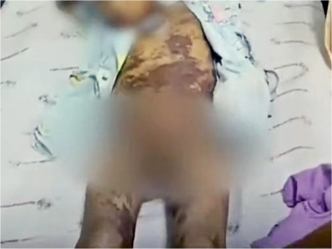 泰国男童被老师淋刺激性药水，导致全身被灼伤。网图