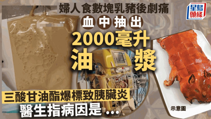 婦人食乳豬後劇痛 揭三酸甘油酯超標致胰臟炎 醫生抽2000毫升油漿保命