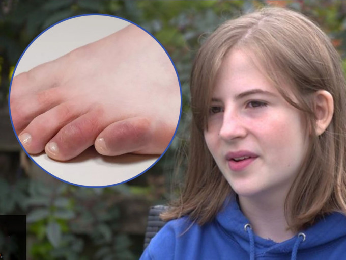 苏格兰13岁少女患「新冠脚趾」，脚趾浮肿发紫起水泡，但检测呈阴性。BBC